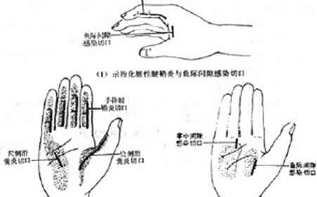 狭窄性腱鞘炎：工伤认定标准及可能的伤残等级划分详解