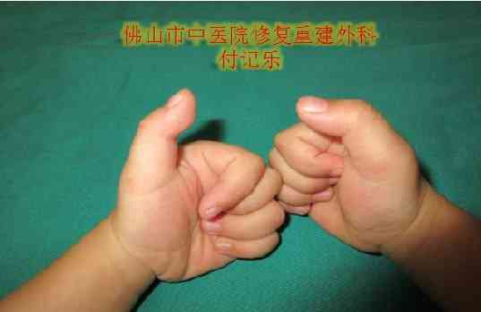 狭窄性腱鞘炎能认定工伤几级吗，手术及工伤待遇解析