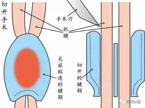 狭窄性腱鞘炎能认定工伤几级吗，手术及工伤待遇解析