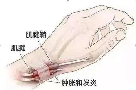 探讨狭窄性腱鞘炎：职业劳损能否界定为工伤？