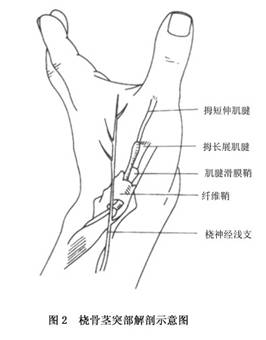 探讨狭窄性腱鞘炎：职业劳损能否界定为工伤？
