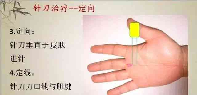 探讨狭窄性腱鞘炎：职业劳损能否界定为工伤？