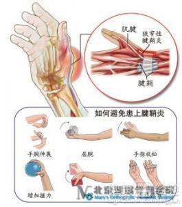 探讨狭窄性腱鞘炎：职业劳损能否界定为工伤？