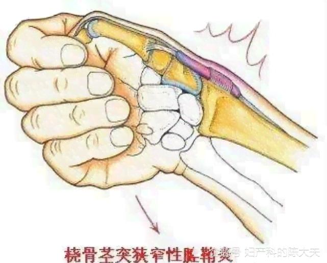 探讨狭窄性腱鞘炎：职业劳损能否界定为工伤？