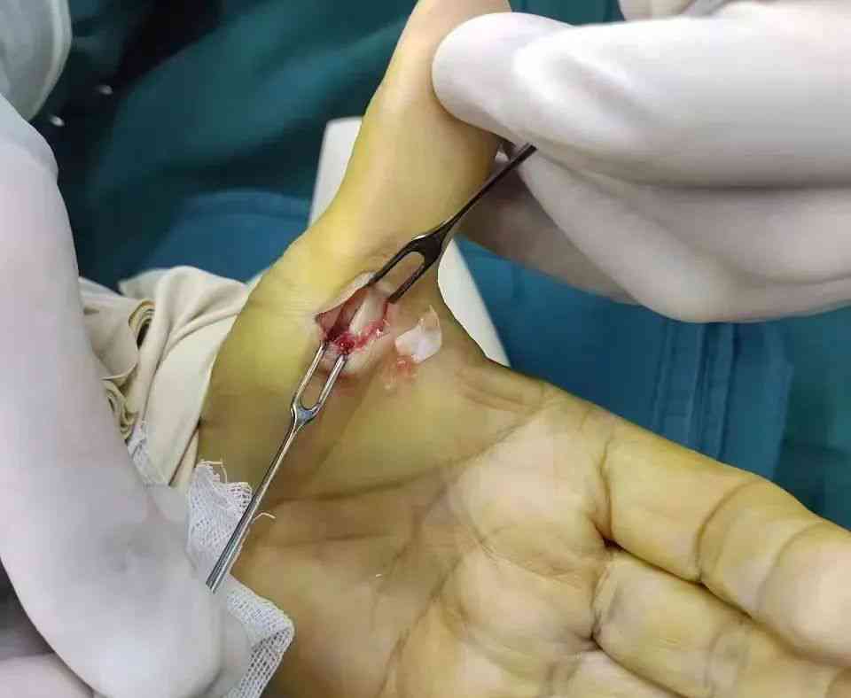 手术治疗狭窄性腱鞘炎：探索有效干预方案