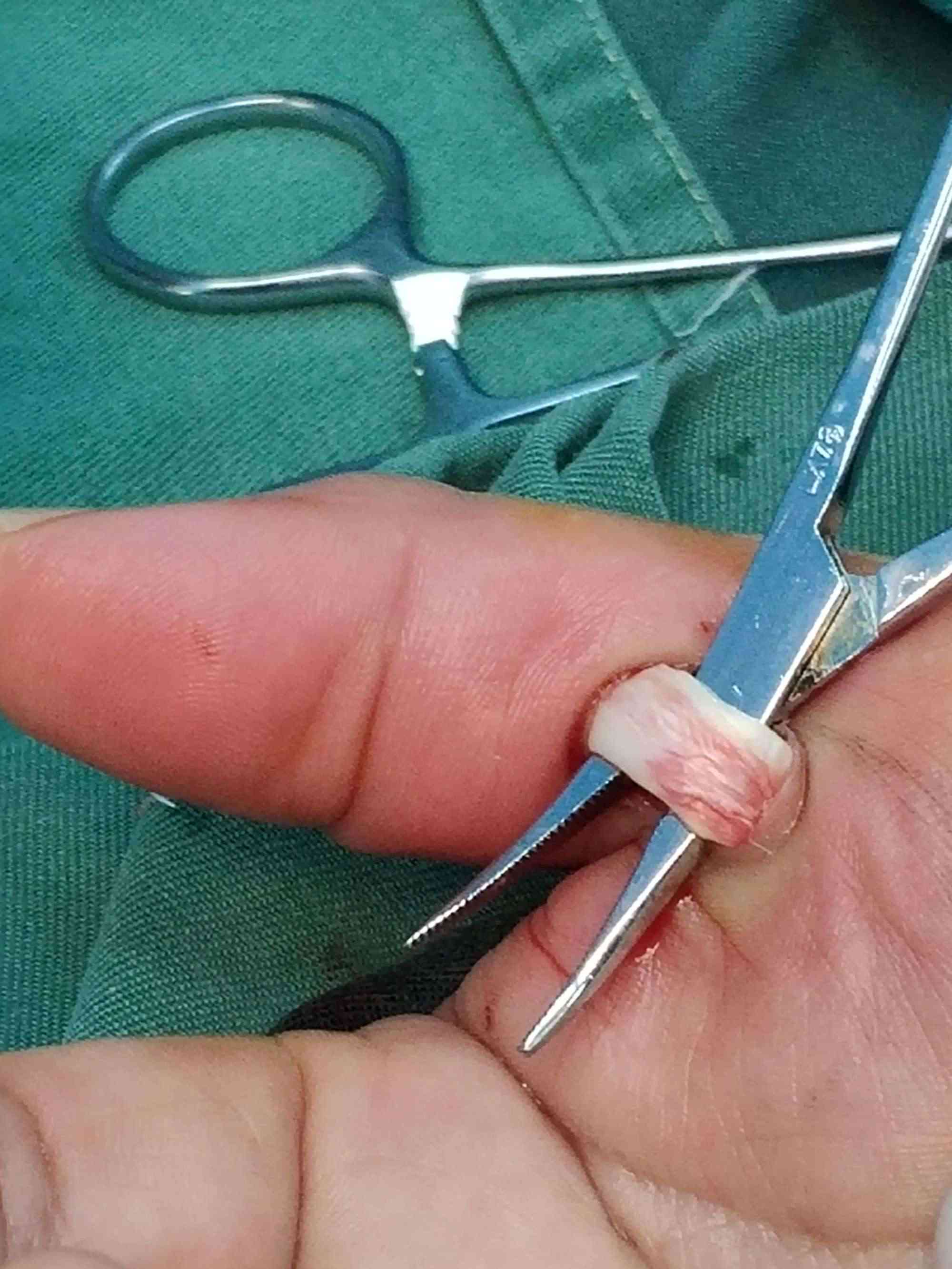 手术治疗狭窄性腱鞘炎：探索有效干预方案