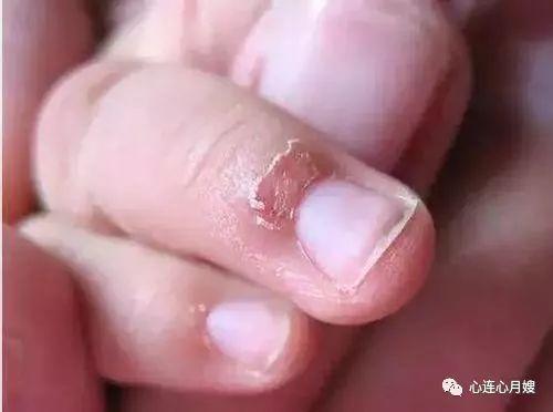 甲沟炎能否被认定为工伤：常见疑问与详细解答