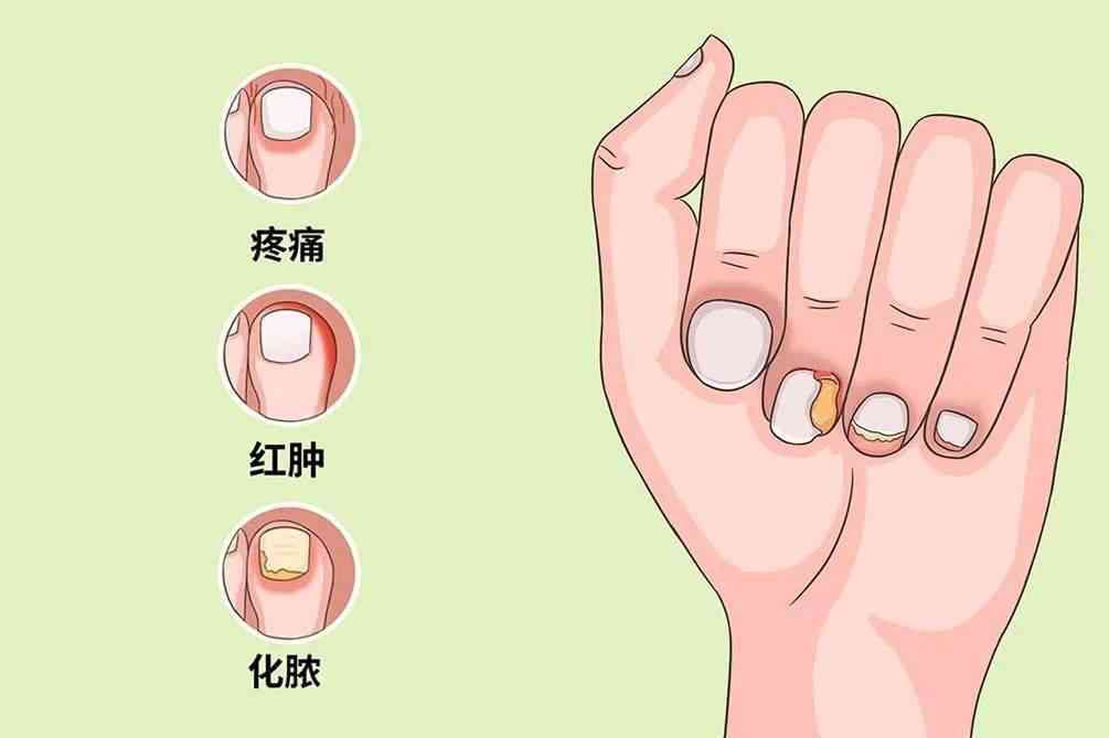 甲沟炎能否被认定为职业病：探讨其职业相关性