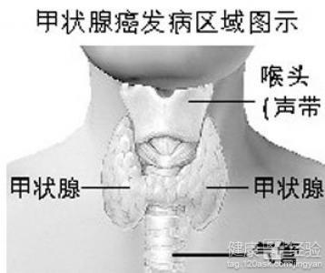 甲状腺癌能认定工伤吗