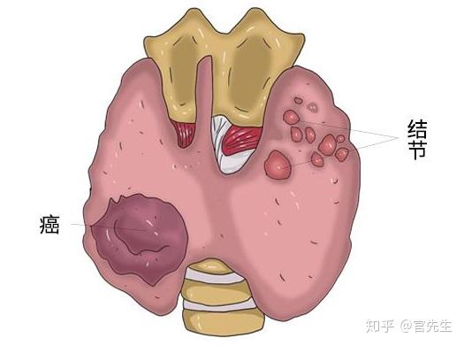 甲状腺癌患者如何申请伤残等级鉴定及条件解析-甲状腺癌能申请伤残鉴定吗