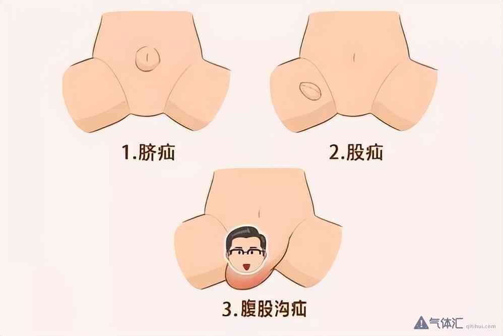 疝气病症与工伤认定的相关性及常见疑问解析