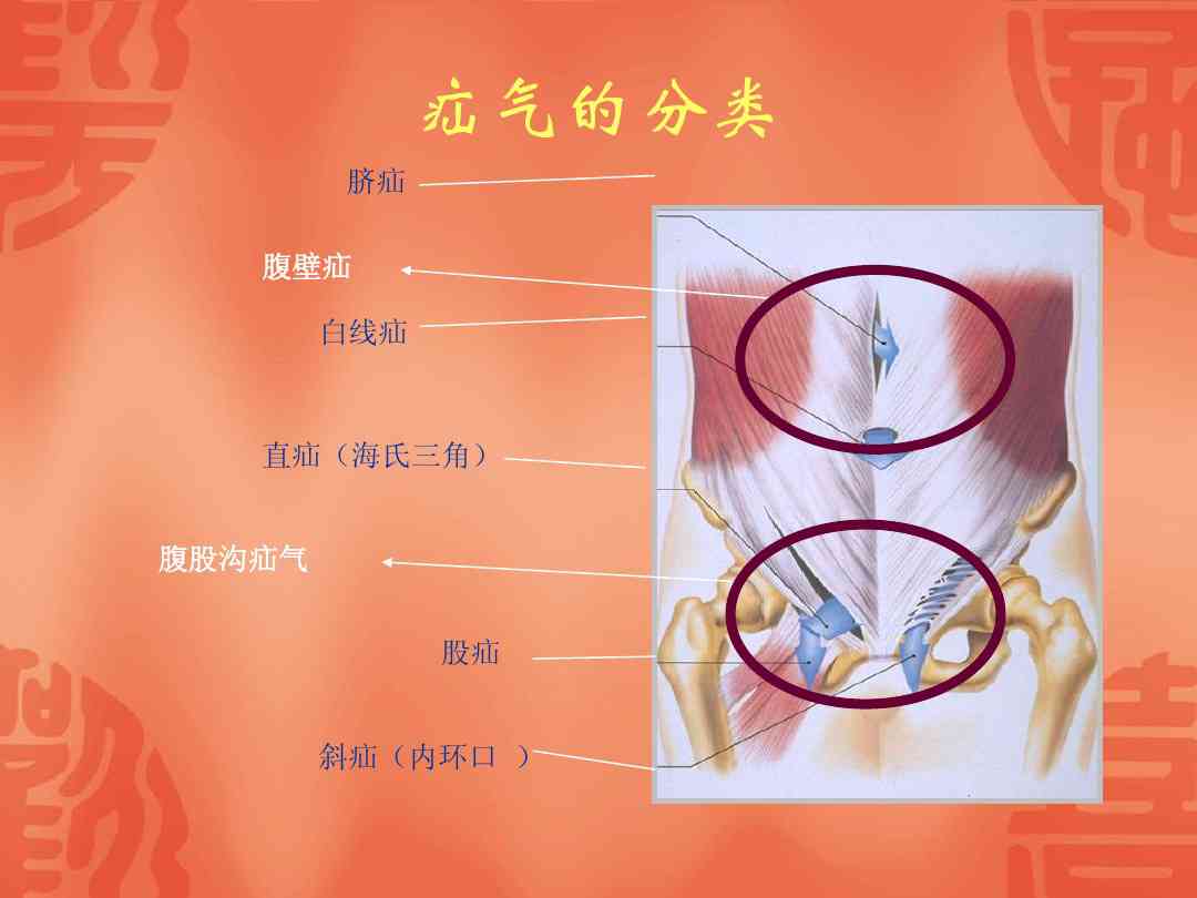 疝气病症与工伤认定的相关性及常见疑问解析