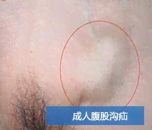 疝气是否可认定工伤 疝气是否可认定工伤
