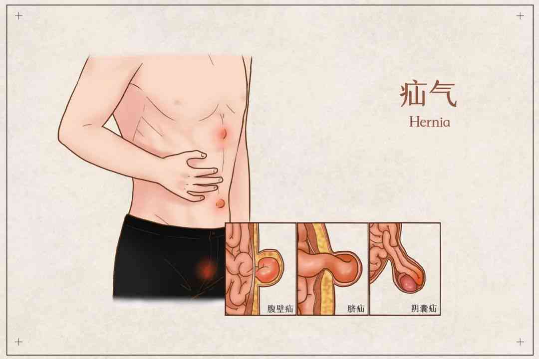 疝气病症是否可被认定为职业工伤的情形探讨