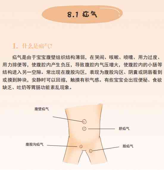 疝气病症是否可被认定为职业工伤的情形探讨
