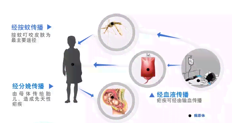 疟疾可以被治愈吗：疟疾的救治与完全治愈可能性探讨
