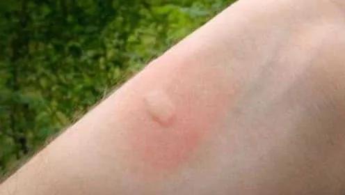 疟疾自愈的可能性与条件探究