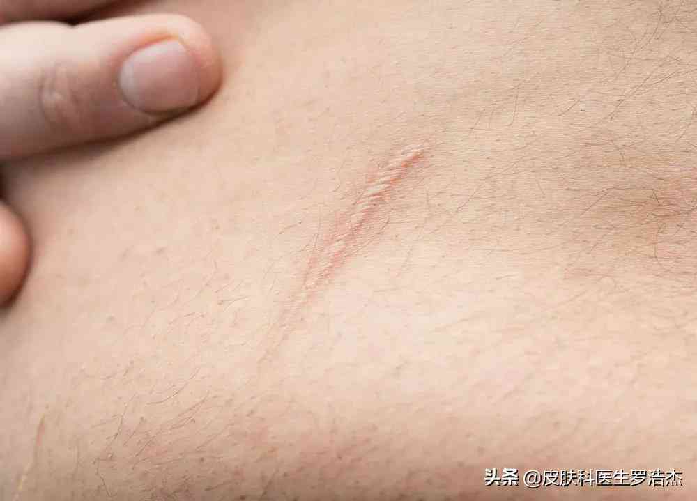 疤痕算不算工伤：工伤事故范围、等级与伤残认定及瘢痕计算方式