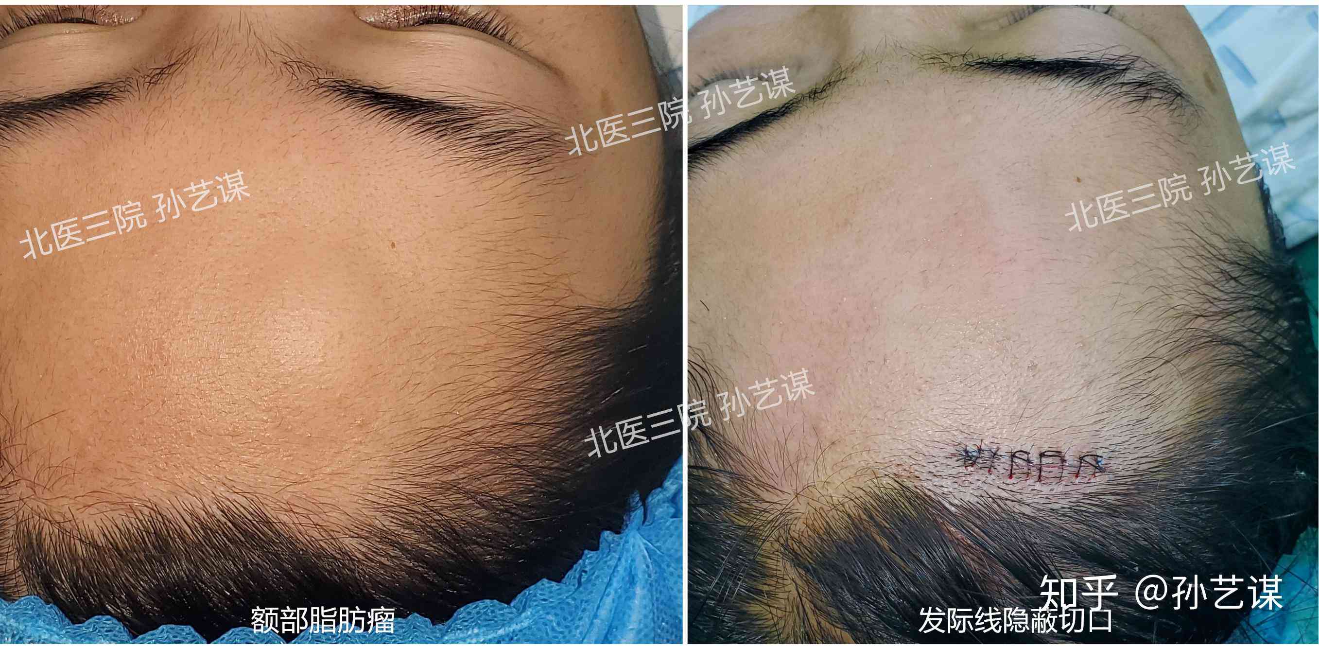 '如何界定疤痕长度：轻度疤痕损伤的标准解析'