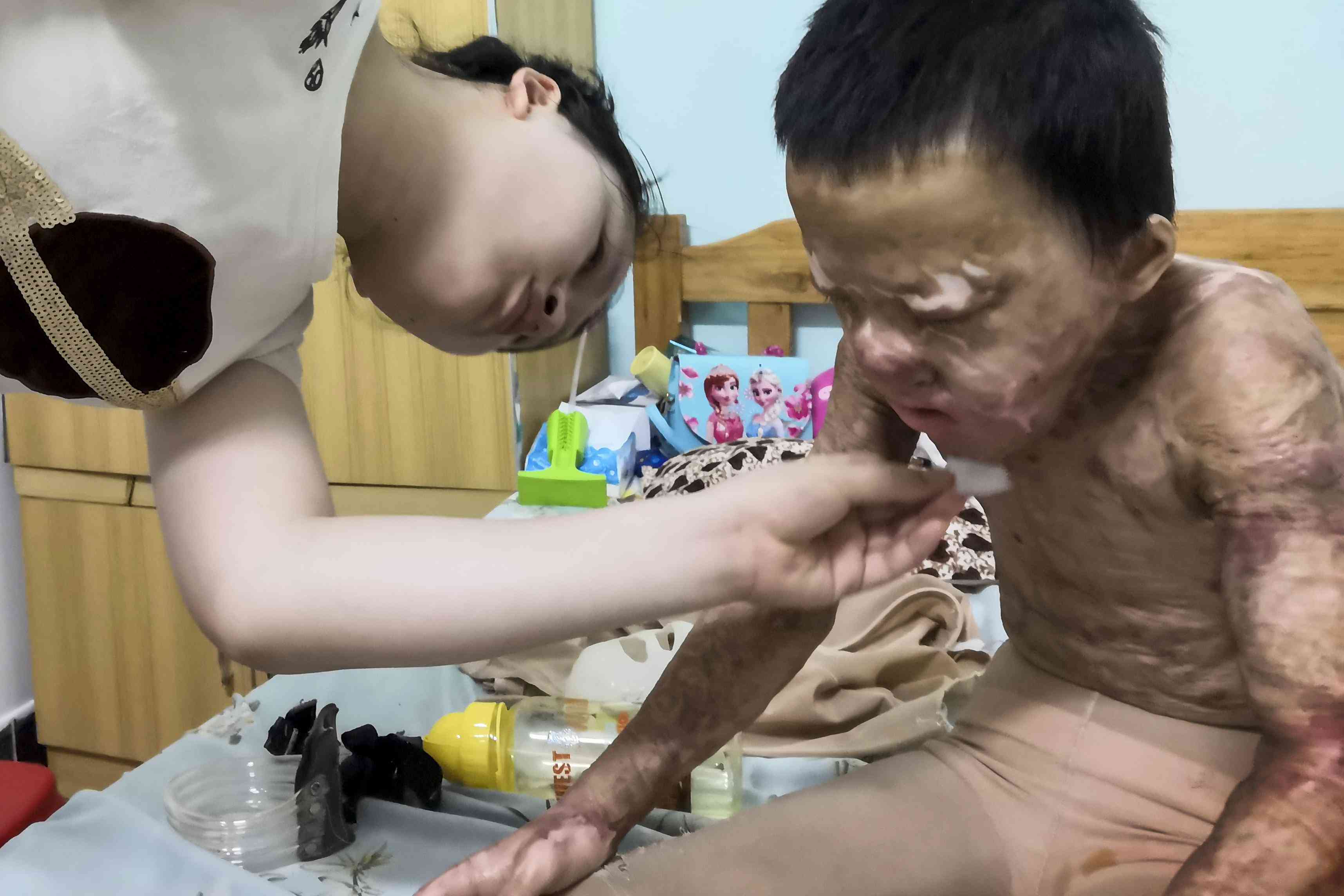 疤痕长度与残疾评定标准：全面解读不同部位疤痕评级条件及流程