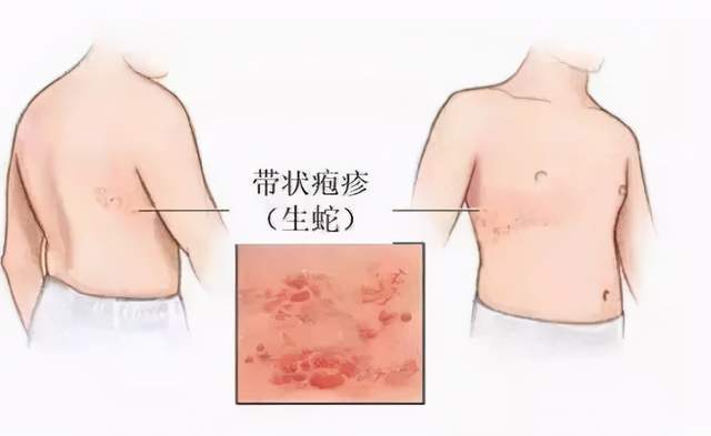 疱疹能认定工伤吗：带状疱疹算工伤吗，能否申报工伤？