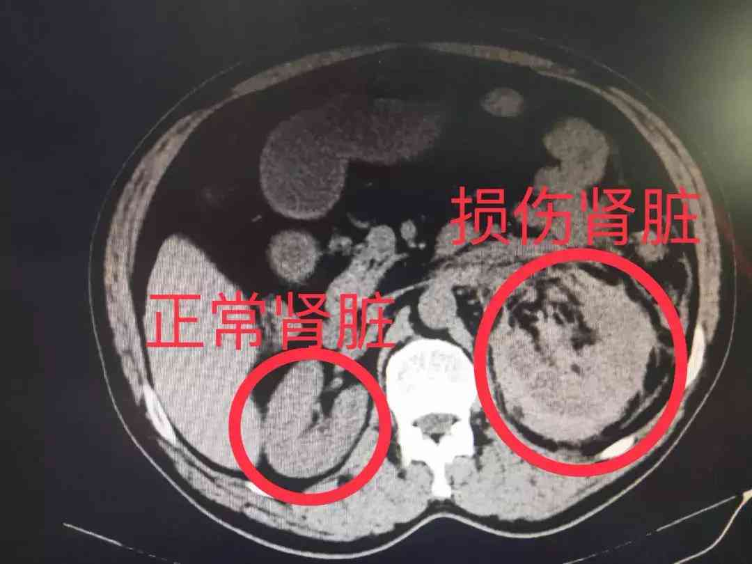 肾挫伤工伤等级判定及工伤赔偿标准详解