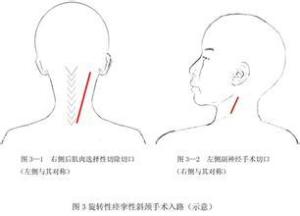 痉挛性斜颈能不能认定工伤及其等级和事故认定