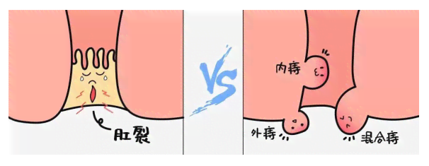全面解析痔疮与肛裂：成因、症状、预防和治疗全攻略