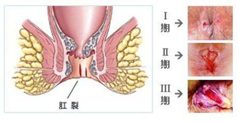 有痔疮和肛裂能顺产吗：女性怀孕及分娩的影响与可能性探讨