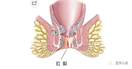 痔疮合并肛裂：探讨综合治疗方案与治愈可能性