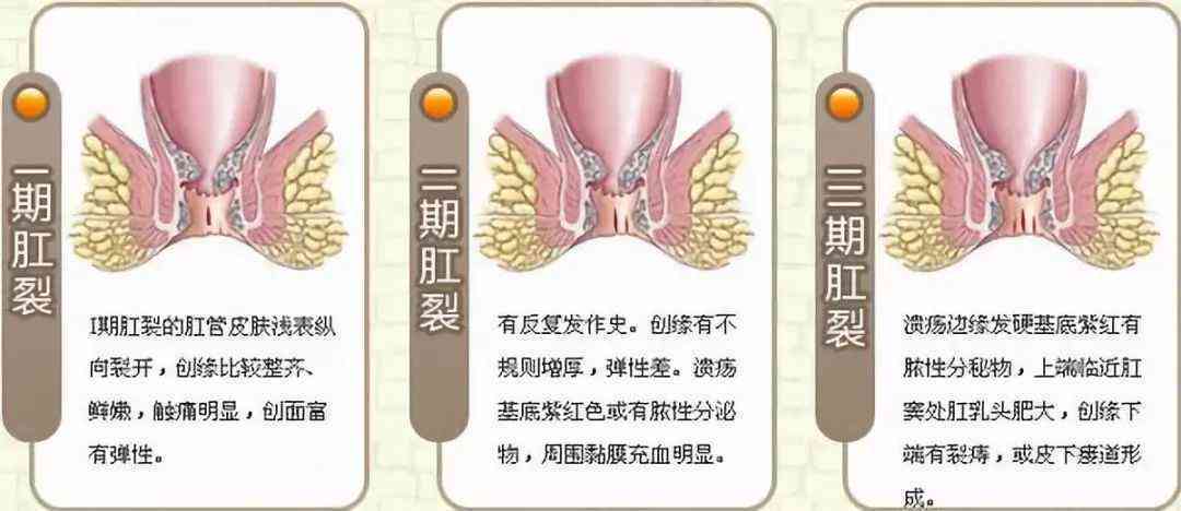 痔疮合并肛裂：探讨综合治疗方案与治愈可能性