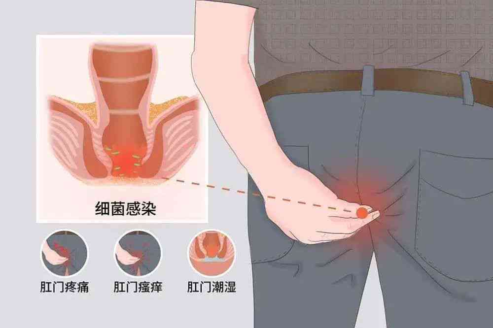 痔疮、肛裂及其癌变风险：全面解析与预防指南