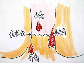 痔疮、肛裂及其癌变风险：全面解析与预防指南