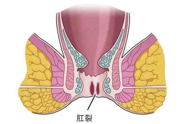 痔疮、肛裂及其癌变风险：全面解析与预防指南