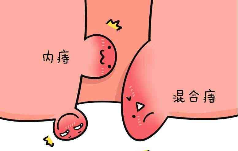 痔疮算不算残疾：痔疮能否定义为残疾人患者及残疾性质探讨