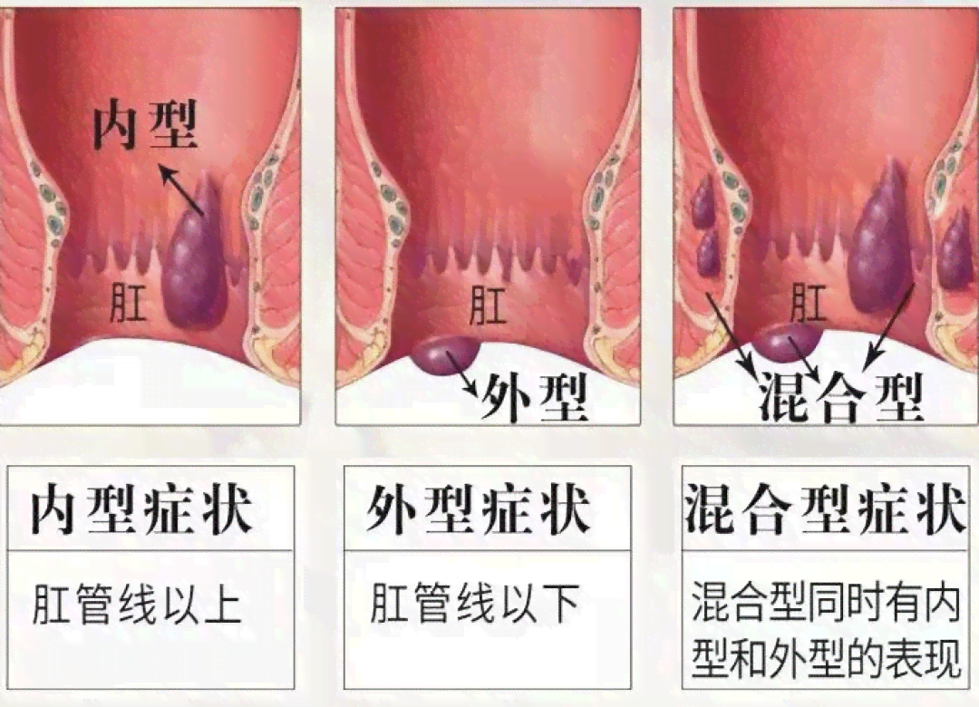 痔疮算不算残疾：痔疮能否定义为残疾人患者及残疾性质探讨