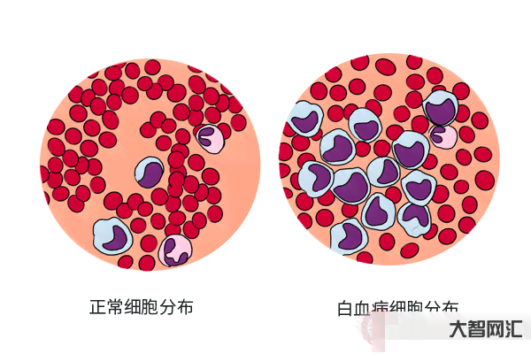 白细胞偏低能入职吗：低白细胞对入职体检的影响