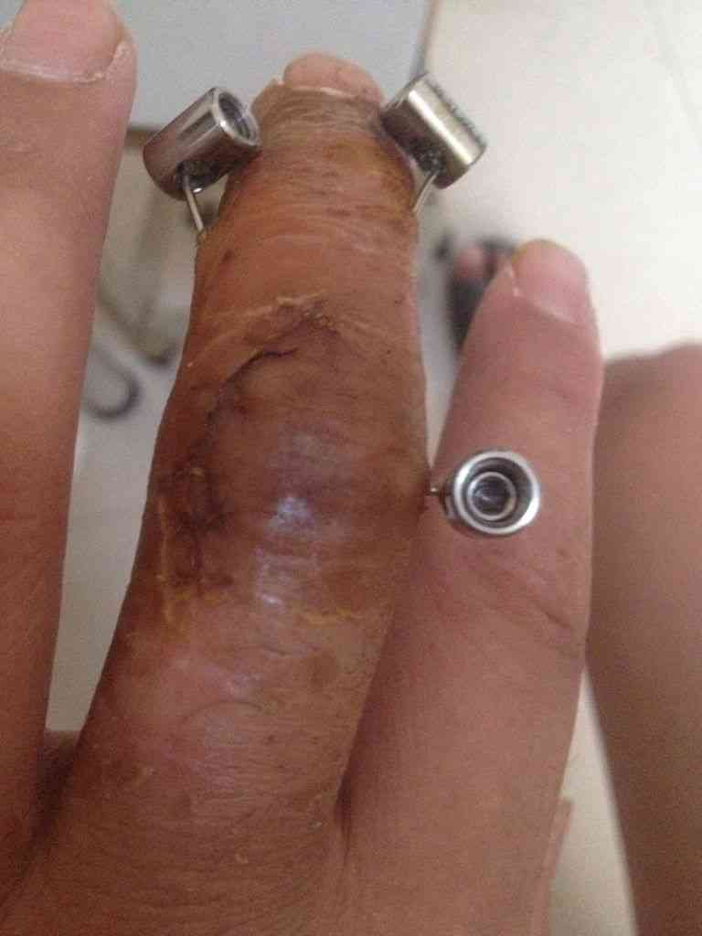 皮外伤能否认定工伤伤残