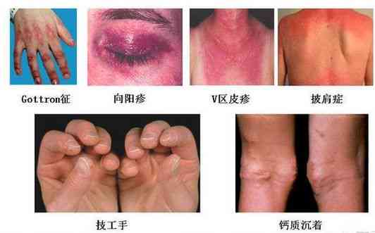 皮肌炎可以认定工伤吗 皮肌炎可以认定工伤吗