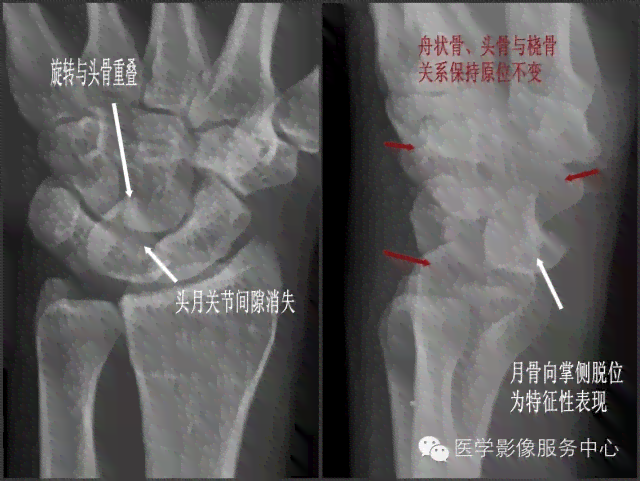 皮质扭曲现象：探究其是否属于骨折及其相关症状与处理方法