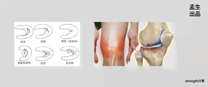 盘状半月板一辈子未受伤：不治疗后果、无需手术可能性、疼痛处理及自愈探讨