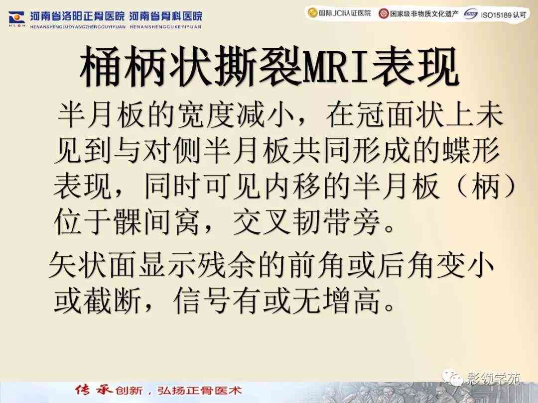 盘状半月板能鉴定伤残吗：损伤算工伤、手术必要性及摘除后评残标准解析