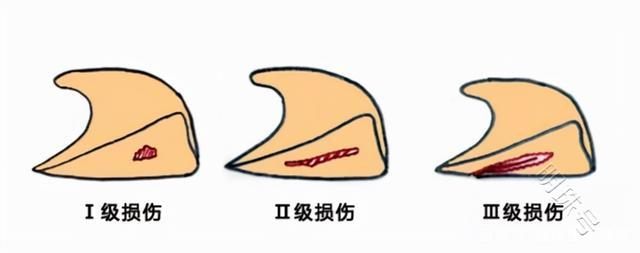 工作中盘状半月板损伤遭遇工伤认定难题：工伤权益如何保障