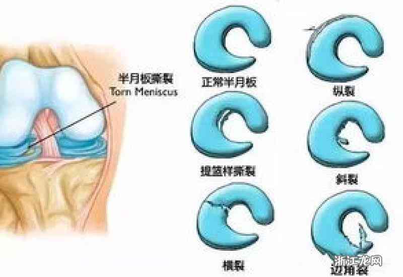 盘状半月板撕裂是否属于工伤：全面解析认定标准及处理流程