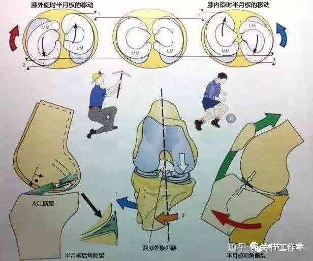 盘状半月板损伤能自愈吗：恢复时长、身影响、遗传因素及运动限制探讨