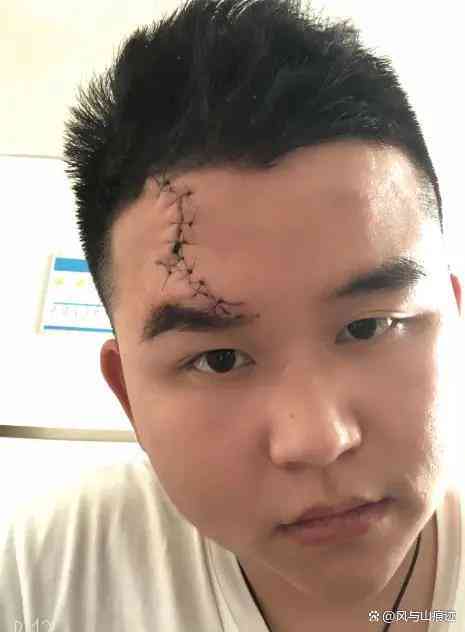 眉毛撕裂能否认定工伤