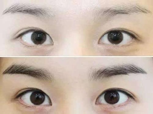 眉毛留疤怎么处理：方法及去除办法一览