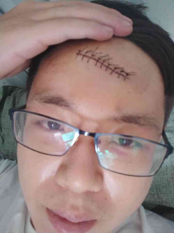 眉毛留疤怎么认定工伤几级