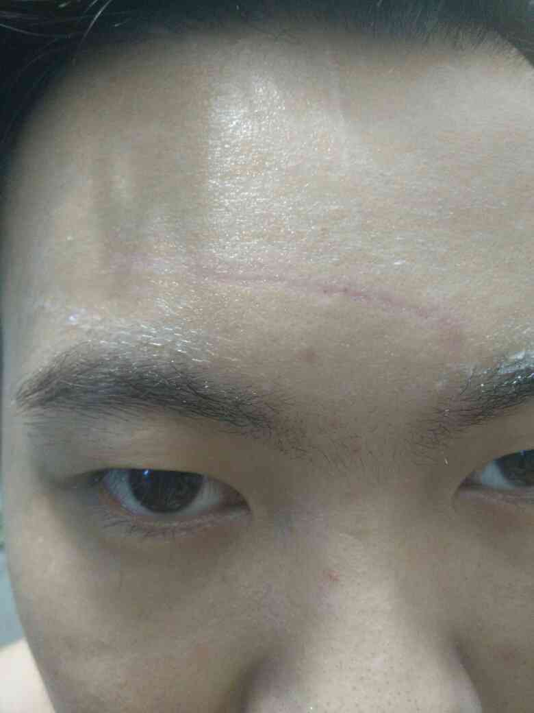 眉骨出血算不算轻伤：是否会留疤及是否属于轻伤二级解析