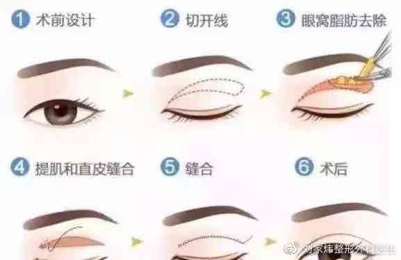 眼皮缝合手术后疤痕预防与恢复全攻略：如何减少疤痕形成及处理常见问题